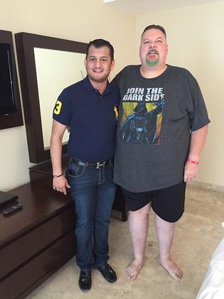 Gastric Bypass Case 1 - Before