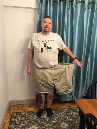 Gastric Bypass Case 1 - After