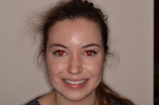 Invisalign: Case 3 - Before invisalign treatment