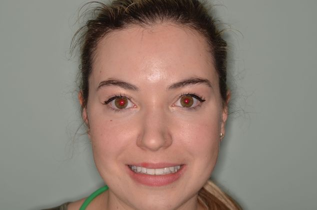 Invisalign: Case 3 - After invisalign