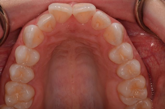 Invisalign: Case 3 - Upper teeth before invisalign