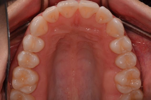 Invisalign: Case 3 - Upper teeth after invisalign