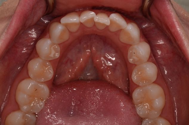 Invisalign: Case 3 - Lower teeth before invisalign