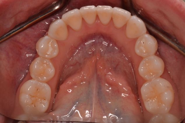 Invisalign: Case 3 - Lower teeth after invisalign