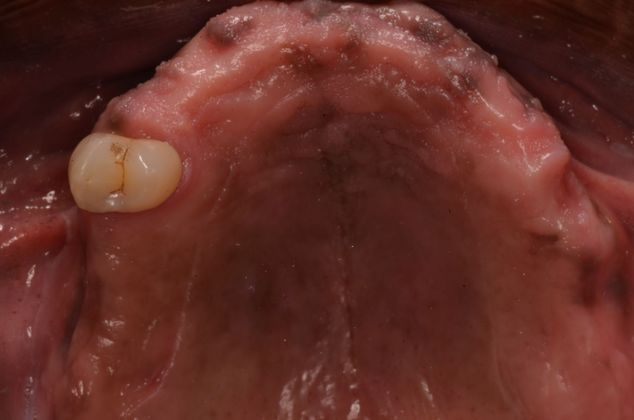 Dental Implants: Case 20 - Upper teeth before treatment