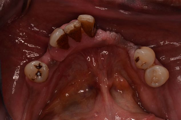 Dental Implants: Case 20 - Lower teeth before treatment