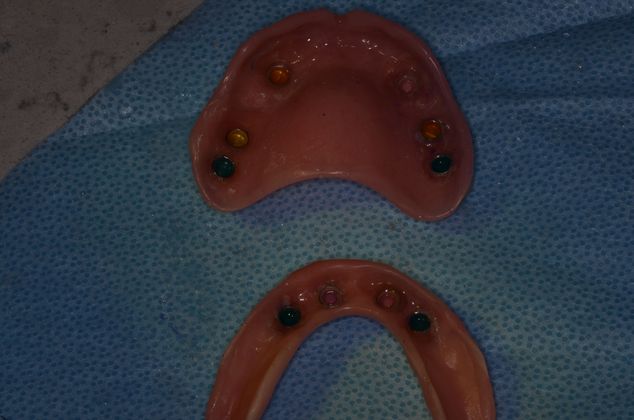 Dentures: Case 9 - Locators, dentures