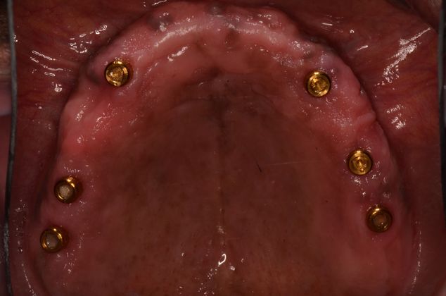Dentures: Case 9 - Upper implants for locators
