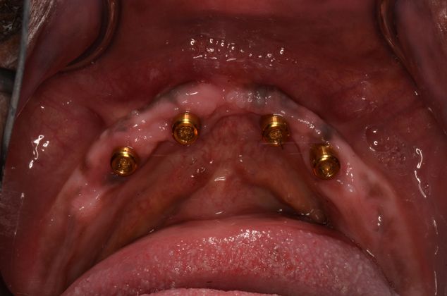 Dentures: Case 9 - Lower locators on dental implants
