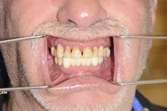 Porcelain Veneers Case 1 - Before