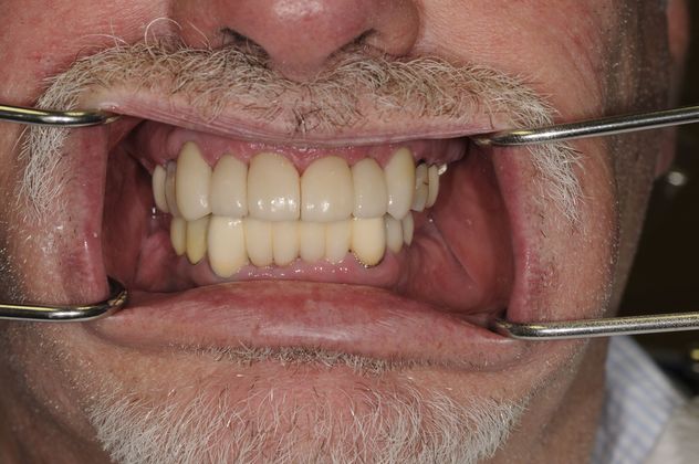 Porcelain Veneers Case 1 - After