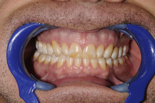 Porcelain Veneers Case 2 - Before
