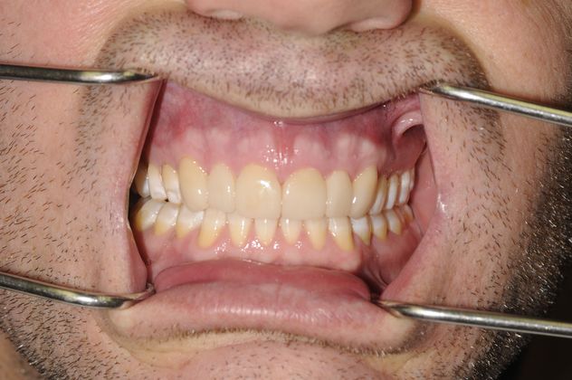 Porcelain Veneers Case 2 - After