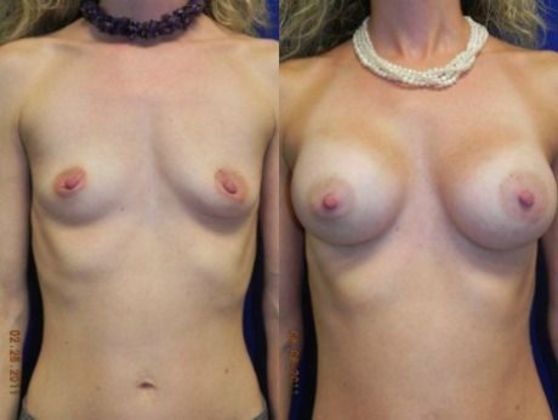 Breast Augmentation Cases