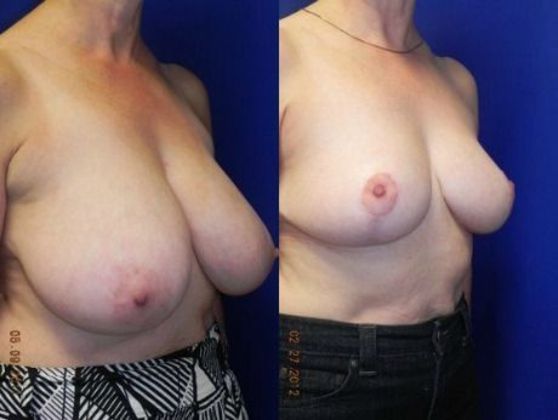 Breast Reduction Cases