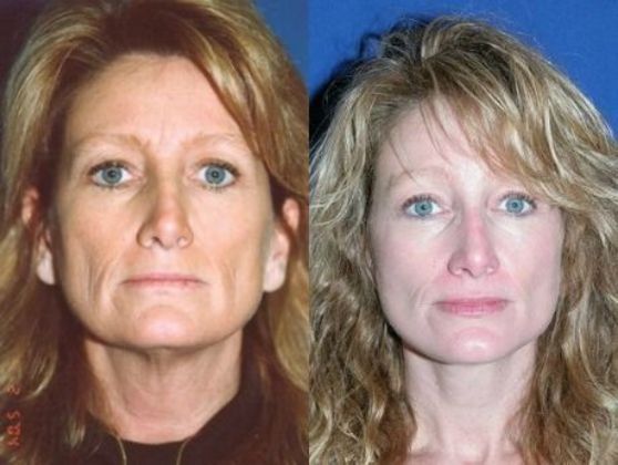 Facial Brow Lift Cases