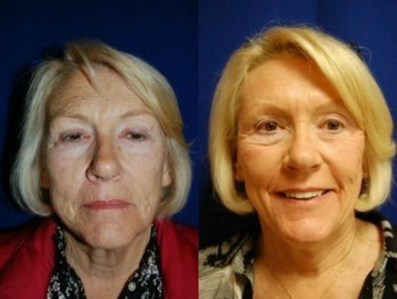 Facial Laser Resurfacing Cases