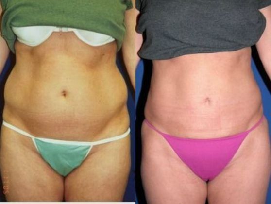 Body Liposuction Cases
