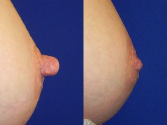 Breast Nipple & Areola Cases