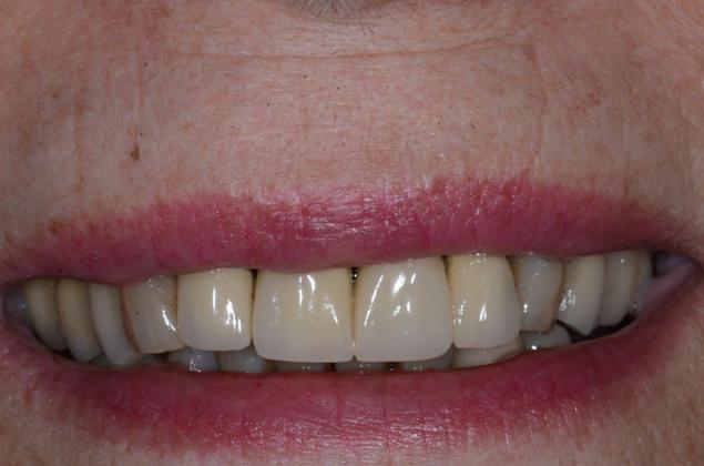 Porcelain Veneers: Case 40: Furlong PA - Before