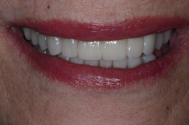 Porcelain Veneers: Case 40: Furlong PA - After