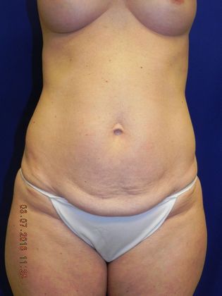 Body Tummy Tuck / Abdominoplasty: Case 13 (20189) - Before