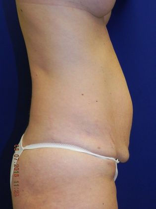 Body Tummy Tuck / Abdominoplasty: Case 13 (20189) - Before