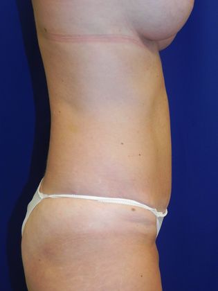 Body Tummy Tuck / Abdominoplasty: Case 13 (20189) - After