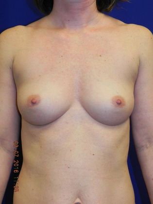 Breast Augmentation : Case 58 (20189) - Before
