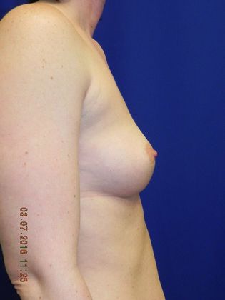 Breast Augmentation : Case 58 (20189) - Before