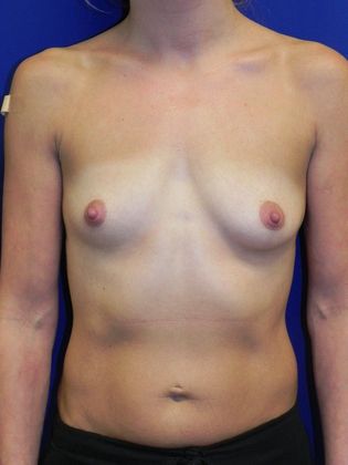 Breast Augmentation : Case 59 (18658) - Before