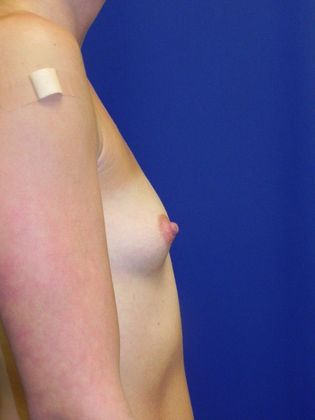 Breast Augmentation : Case 59 (18658) - Before