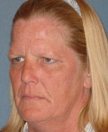 Brow Lift: Aguila Resident Loves Endobrow Results - Before Brow Lift Side