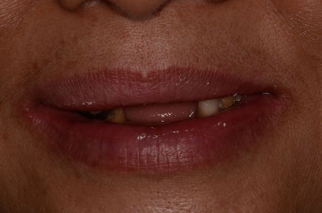 Dentures: Case 10 - Before dentures, hybrids and implants