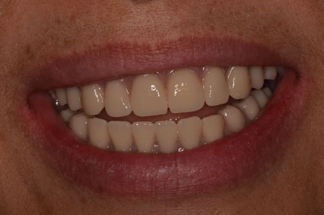 Dentures: Case 10 - Final dentures supported by implants