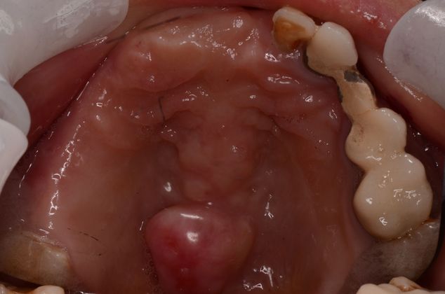 Dental Implants: Case 21 - Before treatment with caries and missing teeth