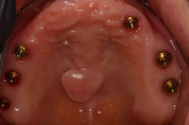 Dental Implants: Case 21 - Upper implants were placed with MIS implants