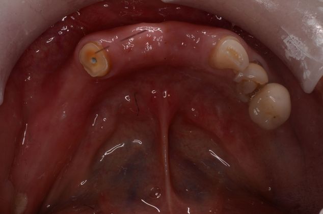 Dental Implants Case 21 - Before