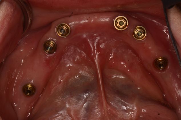 Dental Implants Case 21 - After