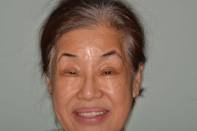 Dental Implants: Case 21 - Final Smile