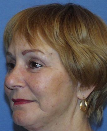 Brow Lift: Sun City West Brow Lift Surgery Success - After Brow Lift Surgery