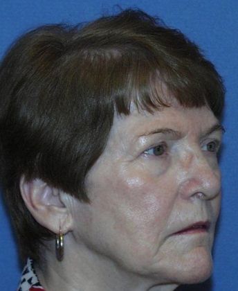 Brow Lift: Sun City West Patient Pleased With Results - Before Brow Lift Surgery