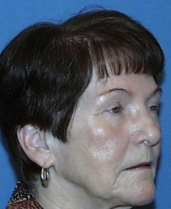 Brow Lift: Sun City West Patient Pleased With Results - After Brow Lift Surgery