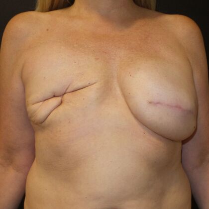 DIEP Flap Breast Reconstruction: Case 34 - Before