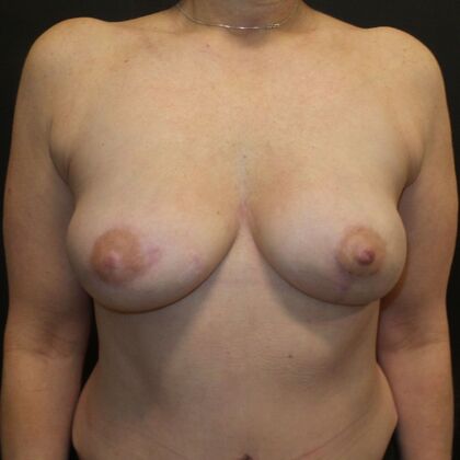 DIEP Flap Breast Reconstruction: Case 36 - After