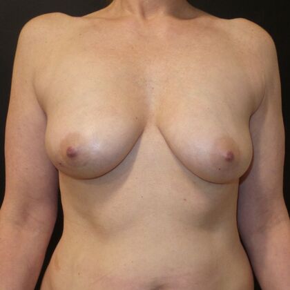 DIEP Flap Breast Reconstruction: Case 36 - Before