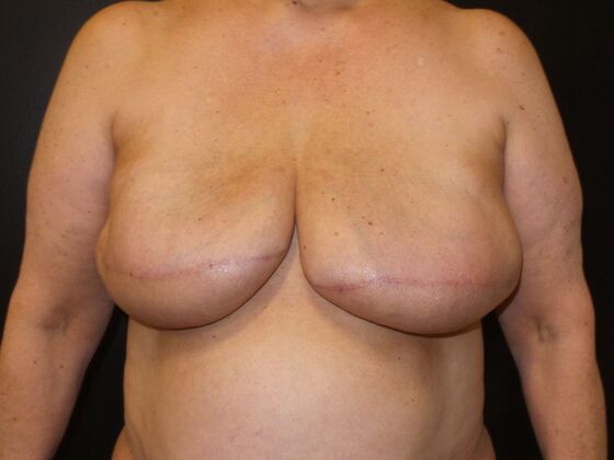DIEP Flap Breast Reconstruction: Case 38 - Before