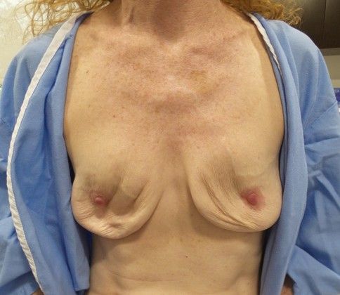 Natural Breast Augmentation with Fat: Case 3 - Before