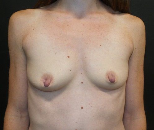 Natural Breast Augmentation with Fat Case 4 - Before