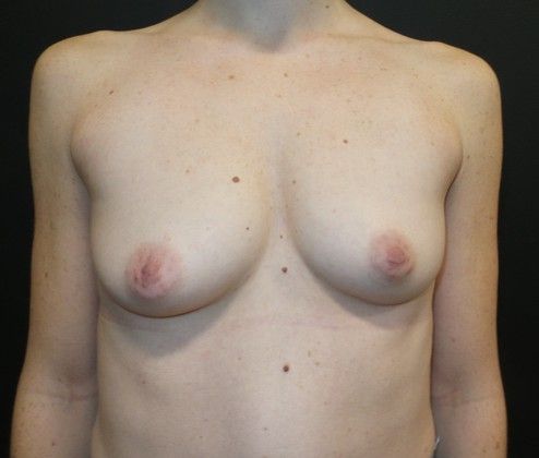 Natural Breast Augmentation with Fat Case 4 - After